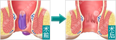 痔疮手术前后对比
